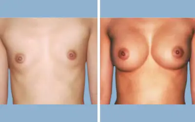 Before and After